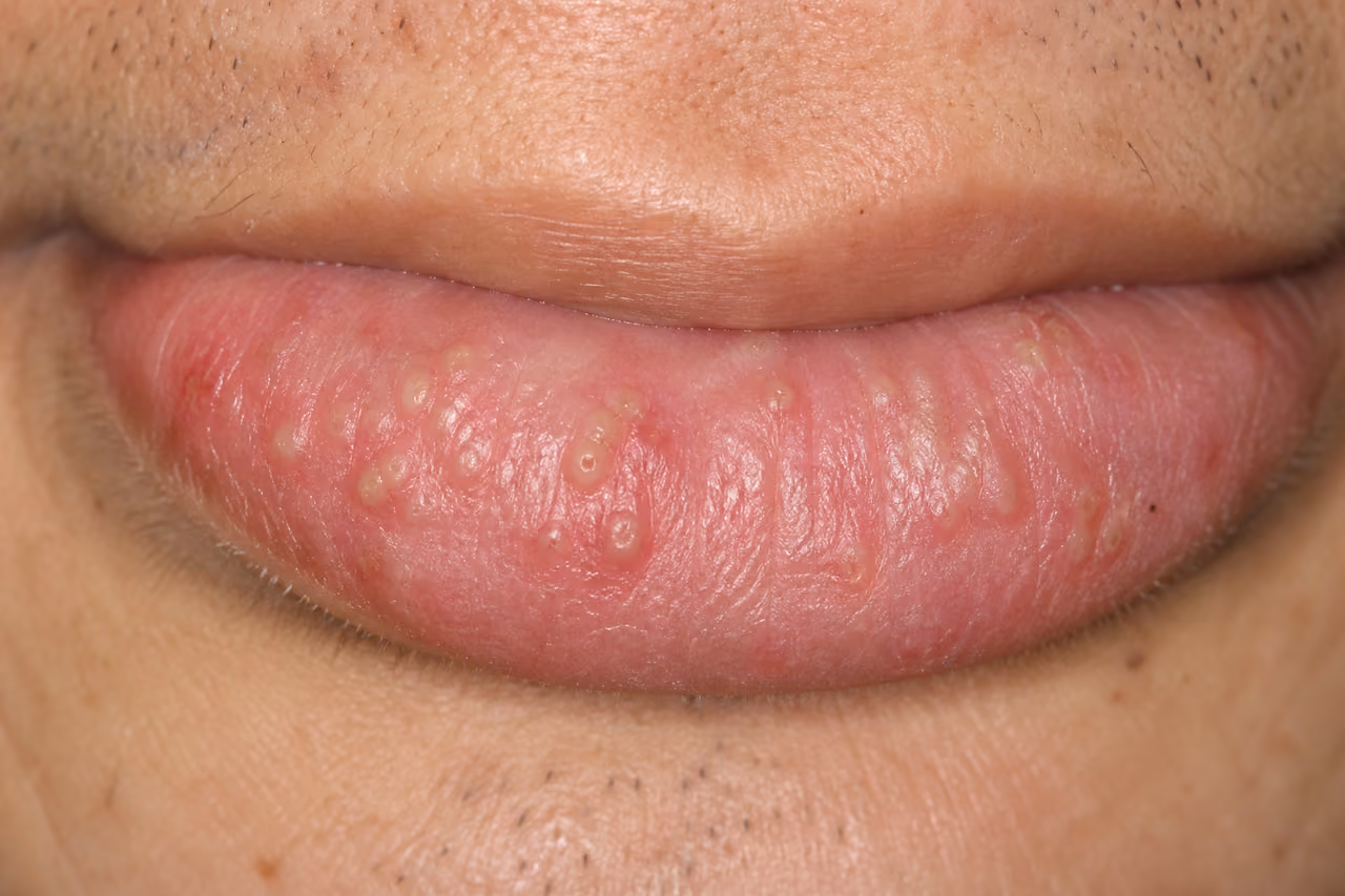 Close-Up of Lower Lip Showing Cheilitis Glandularis Symptoms